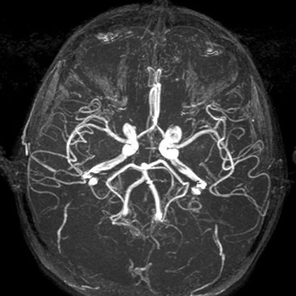Сосуды головного мозга на снимке МРТ с контрастом