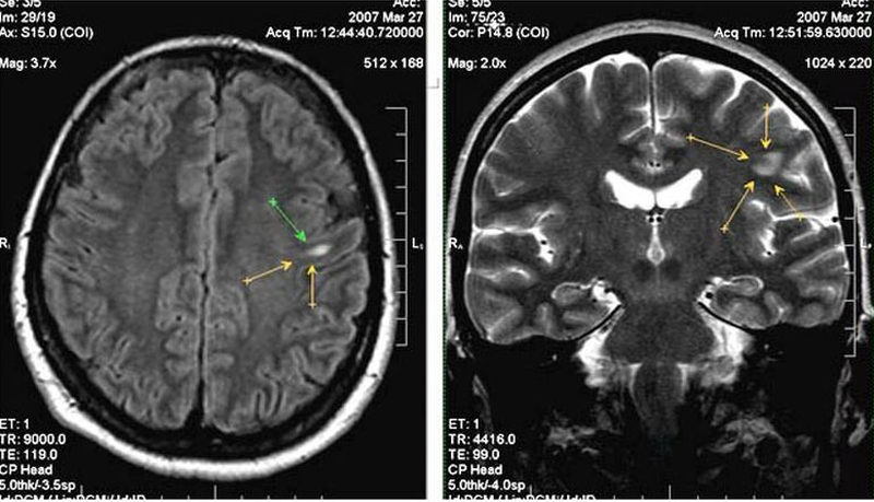 Очаги глиоза в белом веществе головного мозга на снимке МРТ
