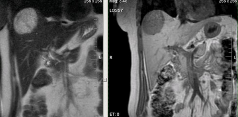 Гепатоцеллюлярный рак на снимке МРТ