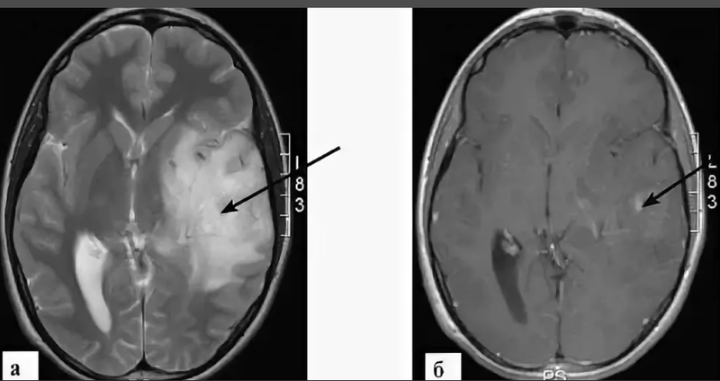 Астроцитома левой височной доли мозга на МРТ
