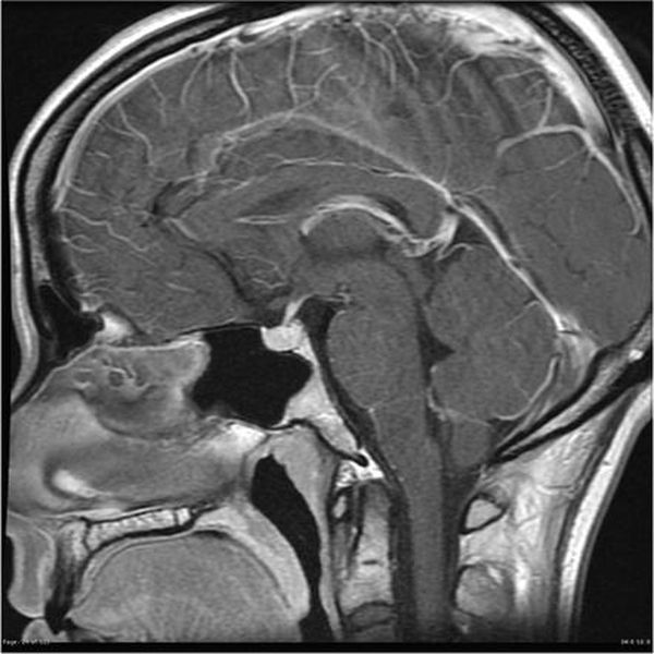 Опухоль гипофиза на МРТ головы с контрастом