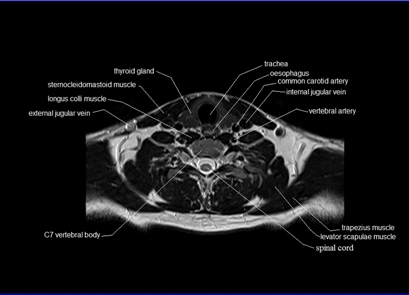 Снимок МРТ мягких тканей шеи