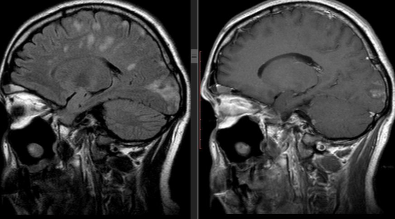 МРТ снимок нейроборрелиоза