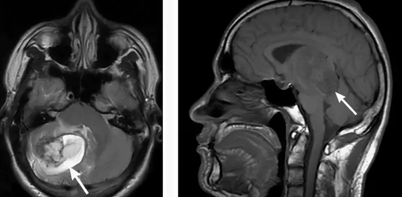 Опухоль головного мозга на снимке МРТ