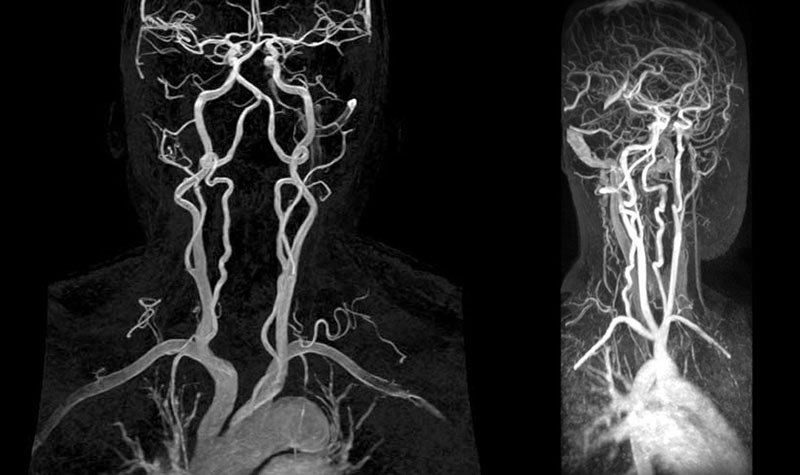 МР-ангиограмма сосудов головного мозга и шеи