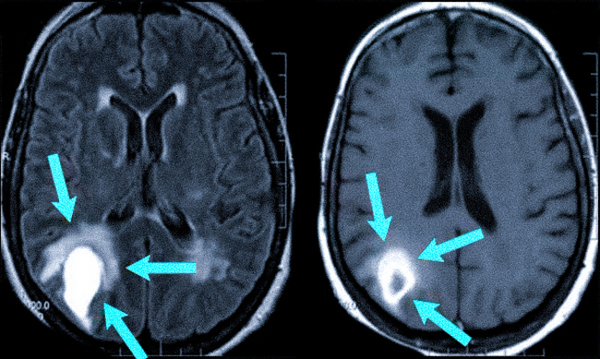 КТ основания черепа