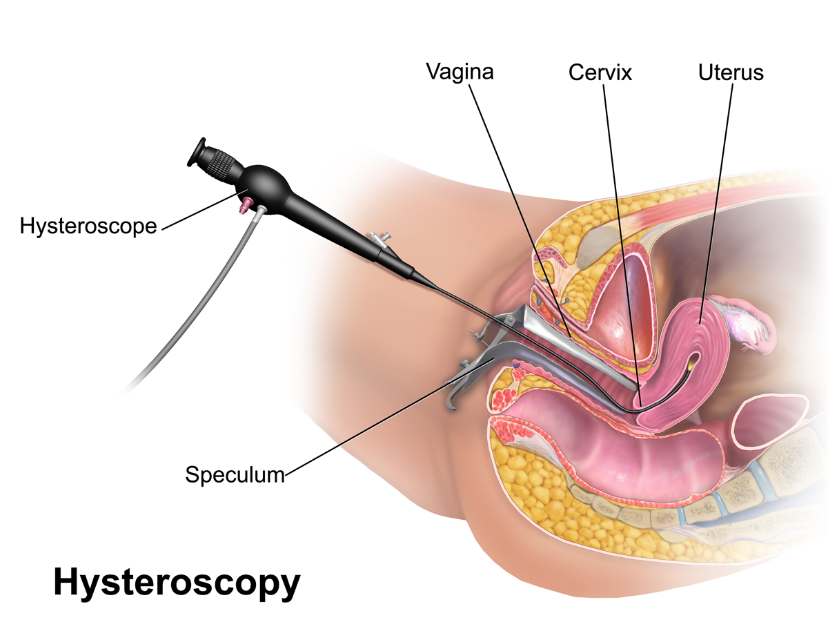 hysteroscopiya