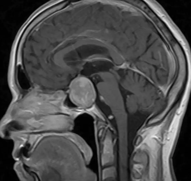 МРТ гипофиза головного мозга