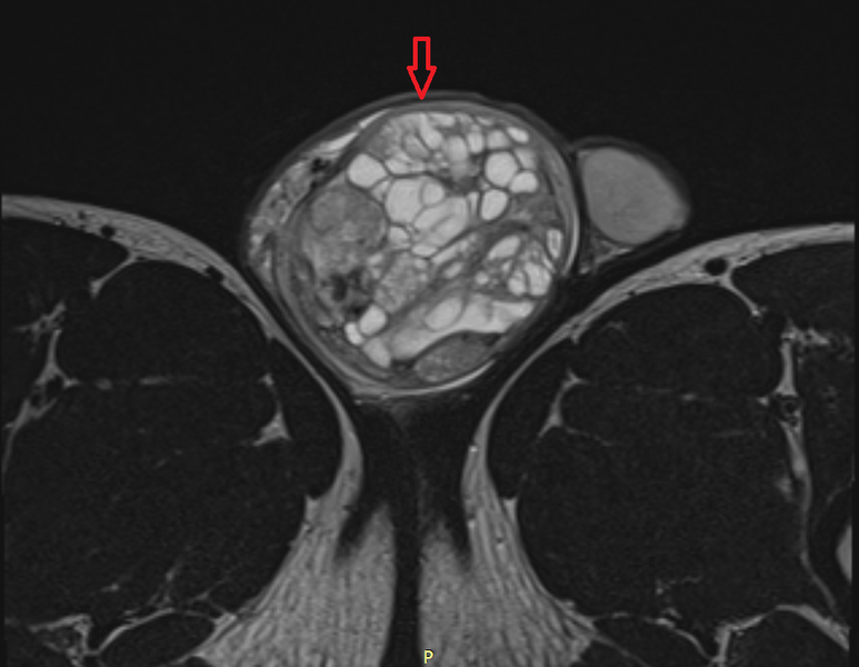 МРТ мужских половых органов семинома яичка