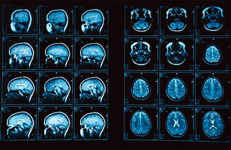 Серия снимков МРТ головного мозга