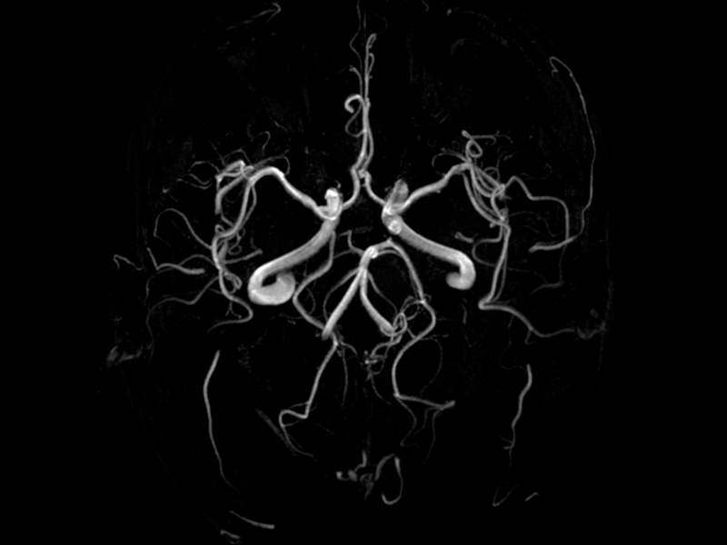 Мрт сосудов. Магнитно-резонансная ангиография сосудов головного мозга. Церебральная ангиограмма сосудов головного мозга. МР-ангиография сосудов головного мозга. Мрт ангиография.