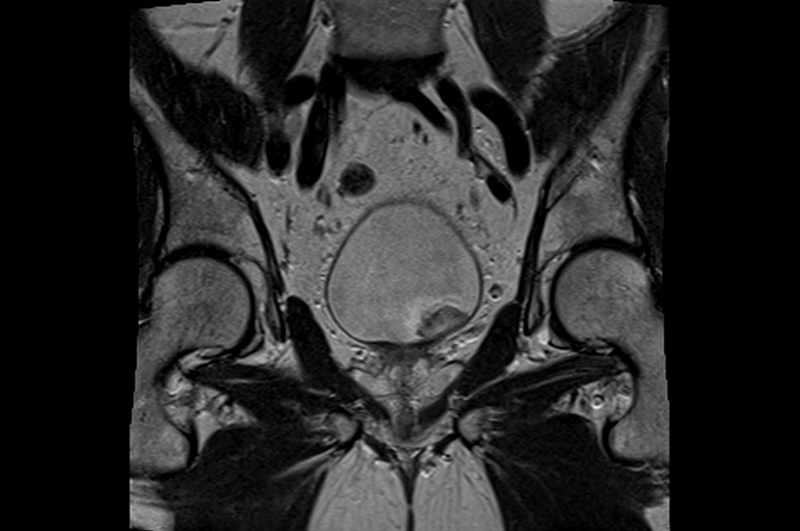 МРТ снимок органов малого таза у мужчины