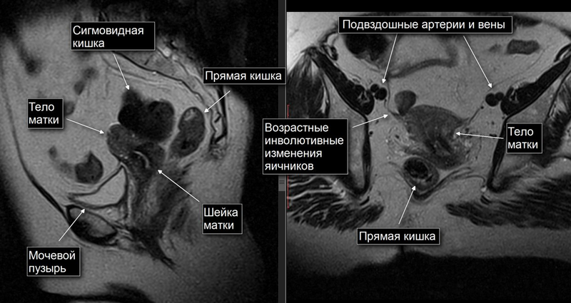 Как выглядит опущение органов малого таза у женщин фотографии