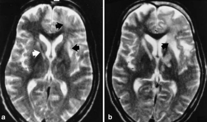 изменения головного мозга на МРТ