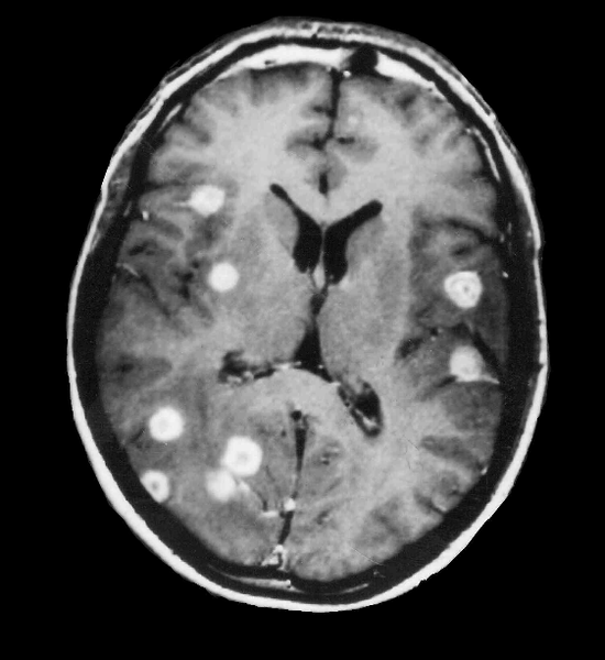 Метастазы рака легкого на МРТ головного мозга