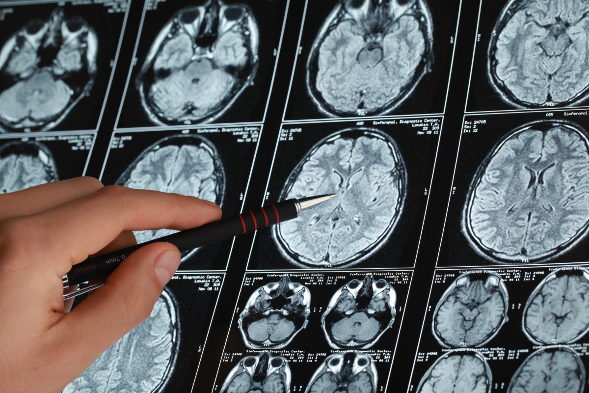Что показывает МРТ головного мозга при эпилепсии