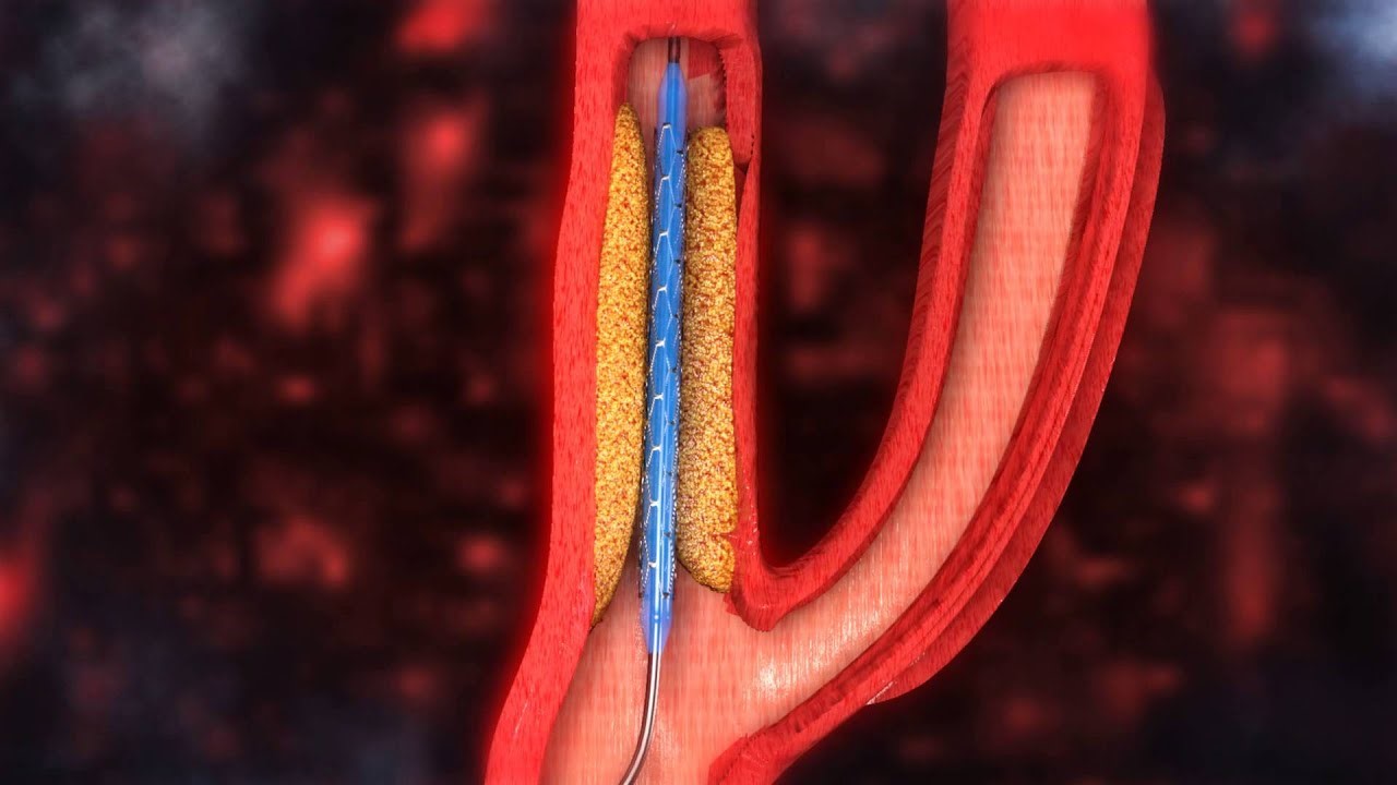 Атеросклеротическая бляшка в сонной артерии
