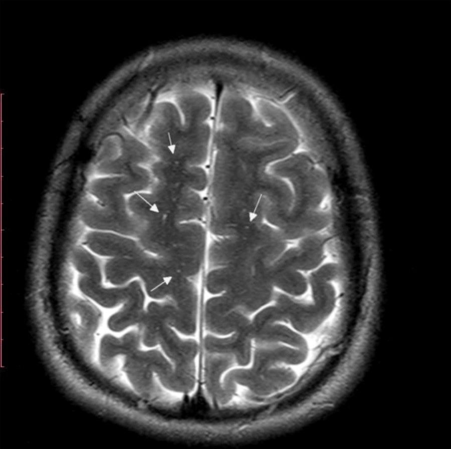 Очаги головного мозга: белое пятно на МРТ головного мозга