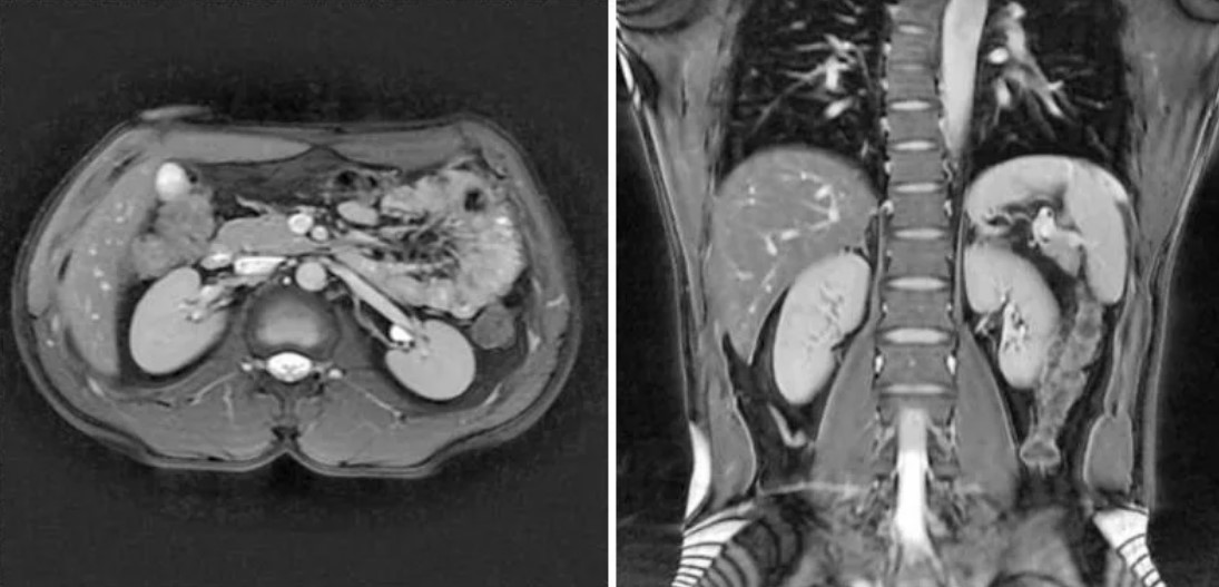 Мрт почек. Кт почек норма. Кт почек снимок.