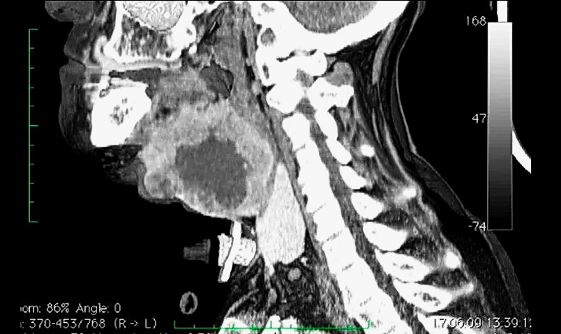 Кт гортани. Метастазы на кт гортани. Новообразование гортани на кт.