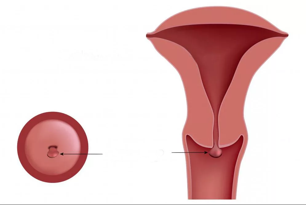 Лечение полипов матки в Турции