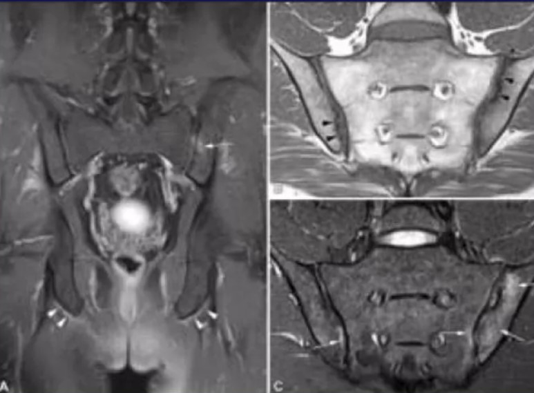 Мрт крестцово подвздошных сочленений режимы. Сакроилеит крестцово-подвздошного сочленения мрт. Туберкулезный сакроилеит мрт.