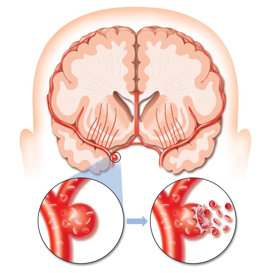 Аневризма головного мозга на МРТ: видна ли, как диагностировать