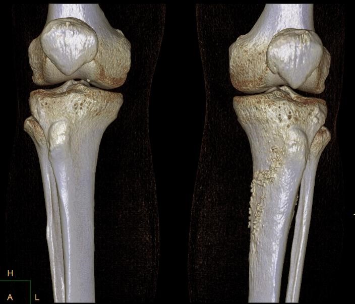 Коленная кость. Бугристость большеберцовой кости кт. Кости коленного сустава.