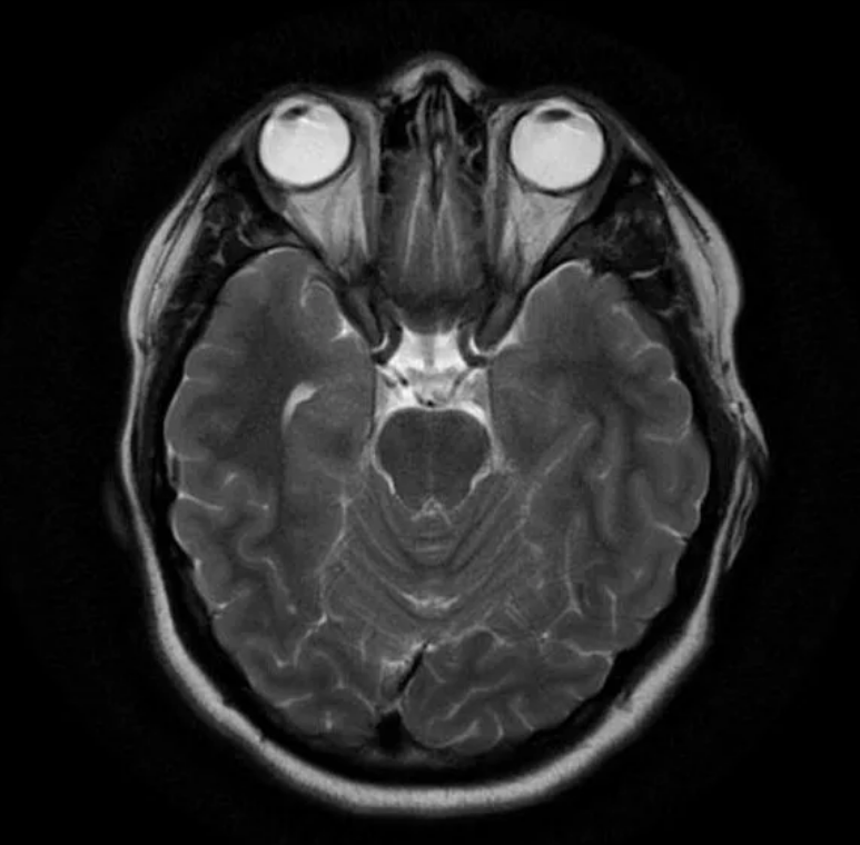 Мрт головного мозга в аксиальной проекции. Рентген головного мозга здорового человека. Мрт снимки мозга. Мрт головного мозга снимок.