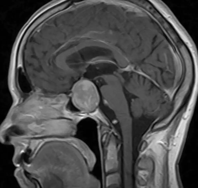 Гипофиз на картинке мозга