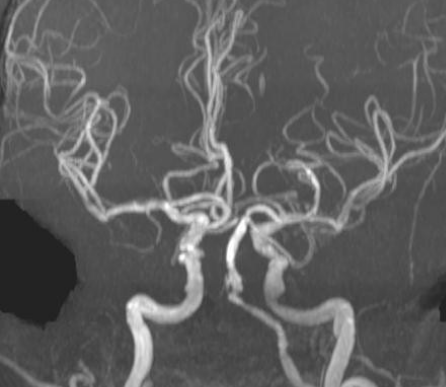 mr-angiografiya-s-kontrastom