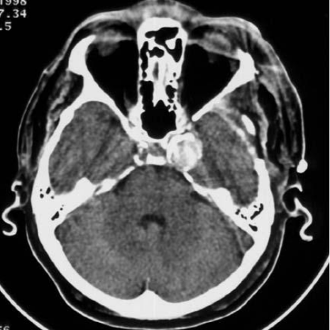 Аневризма головного мозга фото на мрт