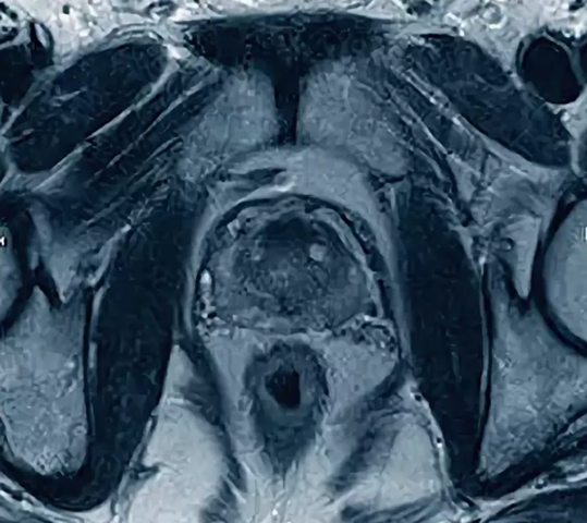 Как выглядит опущение органов малого таза у женщин фотографии