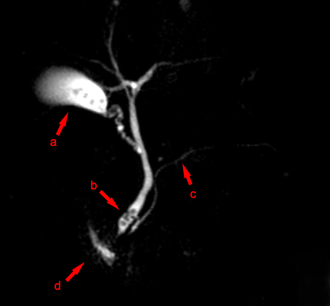 snimok-mr-holangiografii